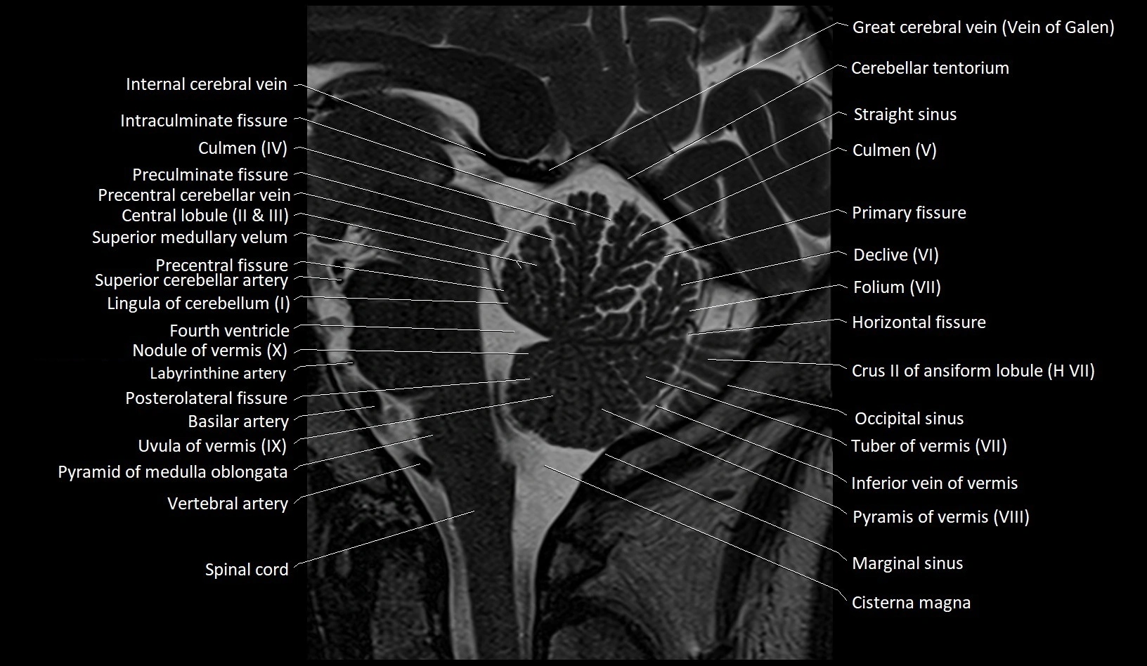 MRI Cerebellar anatomy sagittal High-resolution labelled image 29.webp
